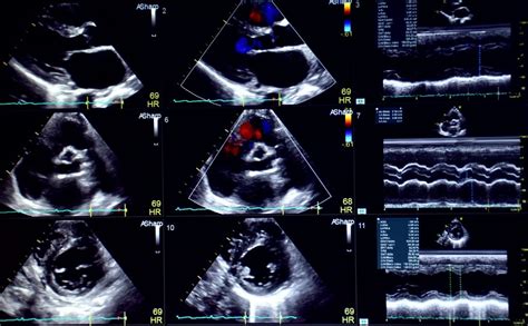bad echocardiogram results|Echocardiogram (Echo) .